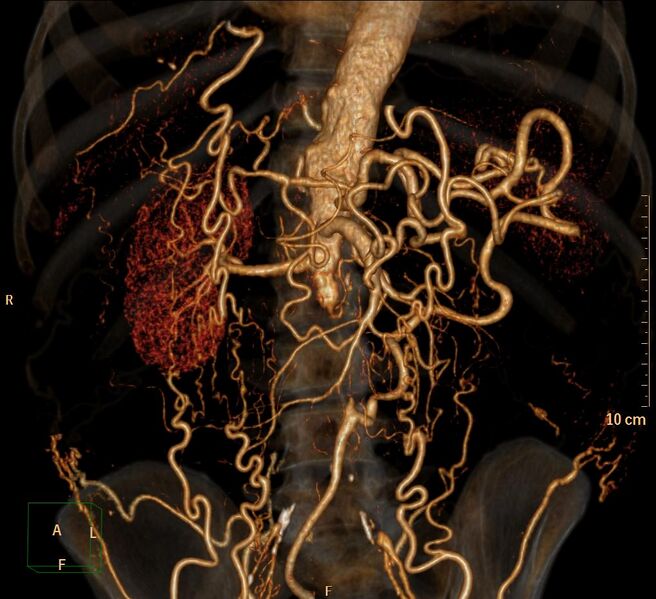 File:Aortoiliac occlusive disease (Radiopaedia 31376-32161 3D-VR-aorta 1).jpg