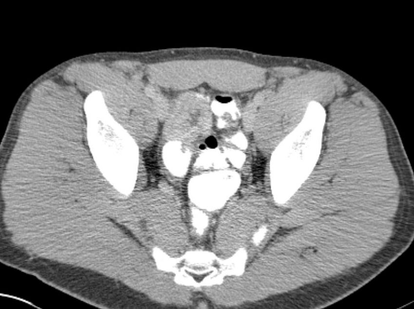 Appendicitis and incidental foregut duplication cyst (Radiopaedia 52962-58916 A 87).jpg
