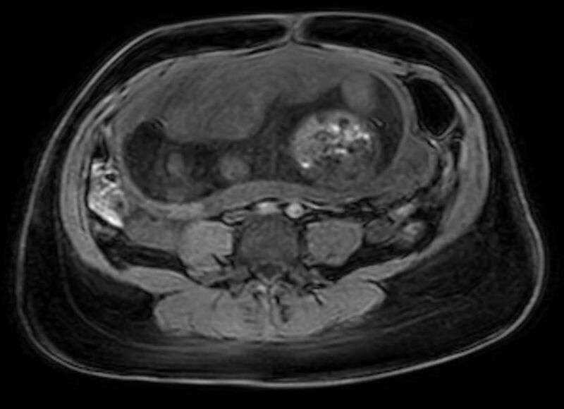 File:Appendicitis in gravida (MRI) (Radiopaedia 89433-106395 Axial DIXON 85).jpg