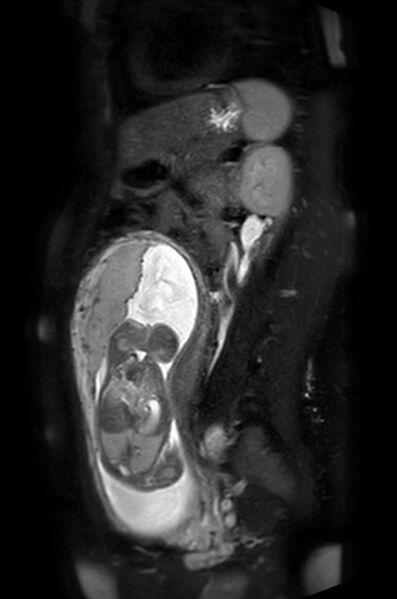 File:Appendicitis in gravida (MRI) (Radiopaedia 89433-106395 Sagittal T2 SPAIR 24).jpg