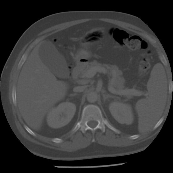 File:Appendicitis with perforation (Radiopaedia 35790-37342 Axial bone window 15).jpg