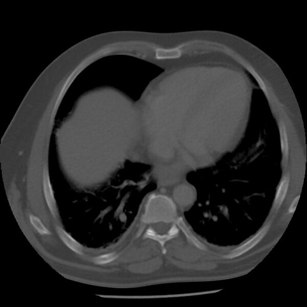 File:Appendicitis with perforation (Radiopaedia 35790-37342 Axial bone window 2).jpg