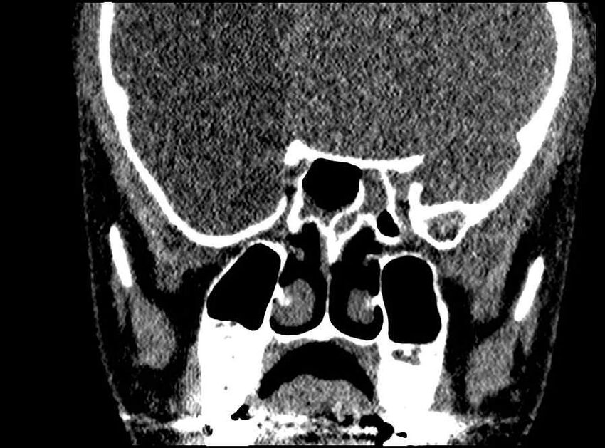 Arachnoid cyst- extremely large (Radiopaedia 68741-78450 Coronal bone window 32).jpg