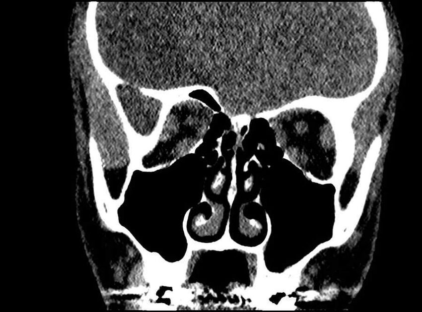 Arachnoid cyst- extremely large (Radiopaedia 68741-78450 Coronal bone window 45).jpg