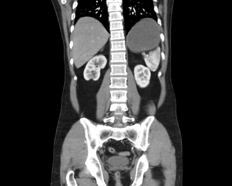 File:Arterial occlusive mesenteric ischemia (Radiopaedia 84641-100060 B 40).jpg