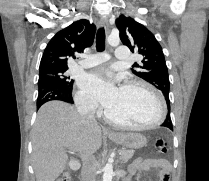 File:Ascending aortic aneurysm (Radiopaedia 86279-102297 B 32).jpg