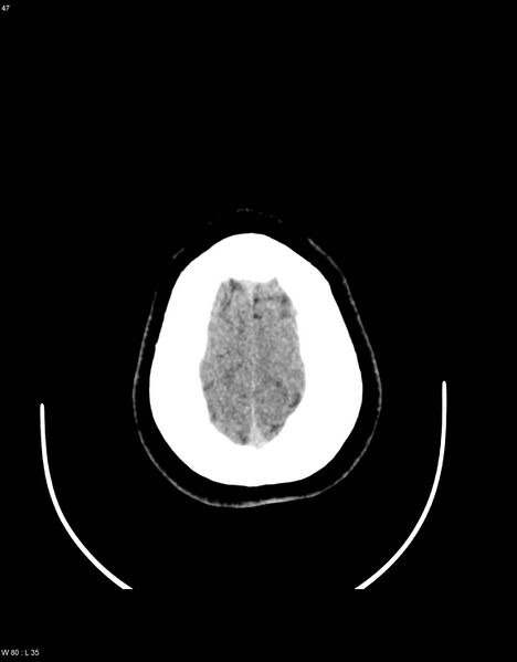 File:Astroblastoma (Radiopaedia 39792-42216 Axial non-contrast 46).jpg