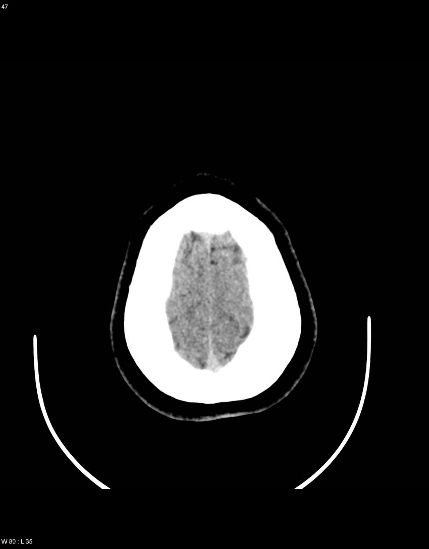 Astroblastoma (Radiopaedia 39792-42216 Axial non-contrast 46).jpg