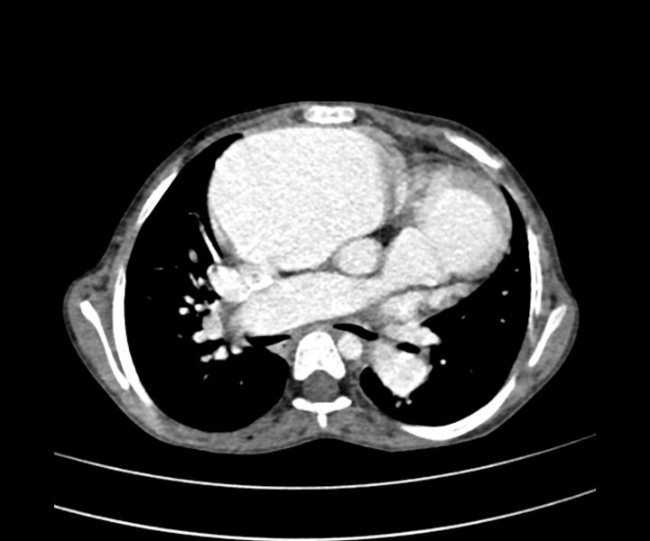 File:Atrial septal defect complicated by Eisenmenger syndrome (Radiopaedia 53707-59768 Axial C+ CTPA 14).jpg