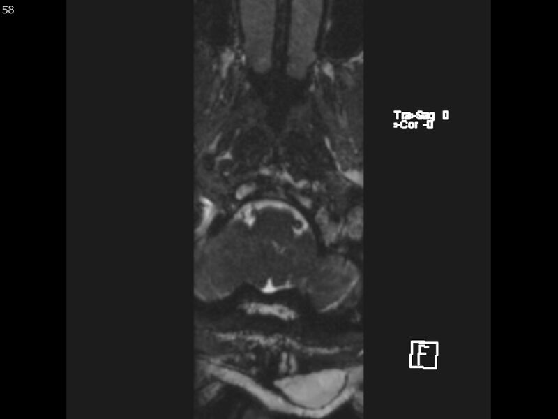 File:Atypical meningioma - intraosseous (Radiopaedia 64915-74572 Axial CISS 58).jpg