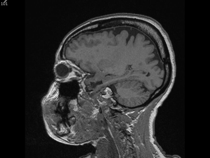 File:Atypical meningioma - intraosseous (Radiopaedia 64915-74572 Sagittal T1 101).jpg