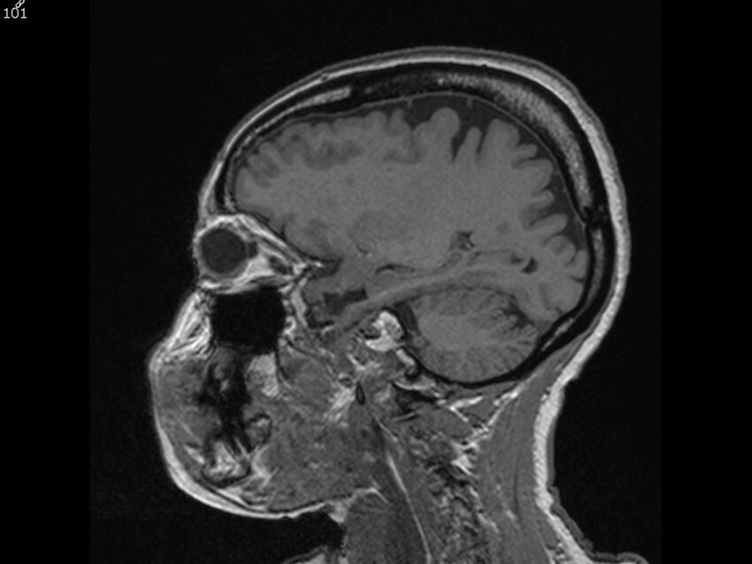Atypical meningioma - intraosseous (Radiopaedia 64915-74572 Sagittal T1 101).jpg
