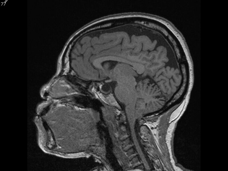 File:Atypical meningioma - intraosseous (Radiopaedia 64915-74572 Sagittal T1 77).jpg