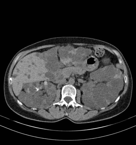 File:Autosomal dominant polycystic kidney disease (Radiopaedia 41918-44922 Axial non-contrast 11).jpg