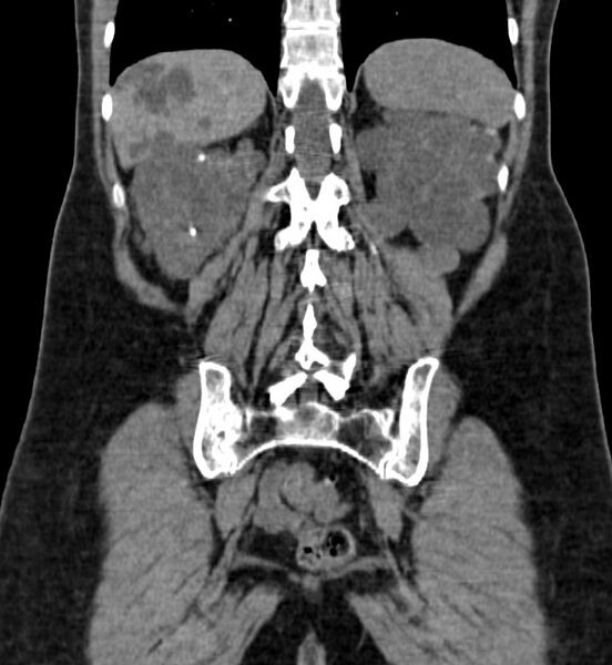 File:Autosomal dominant polycystic kidney disease (Radiopaedia 41918-44922 Coronal non-contrast 40).jpg