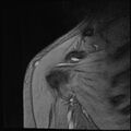 Avulsion fracture - greater tuberosity of humerus (Radiopaedia 71216-81515 Coronal T2 15).jpg
