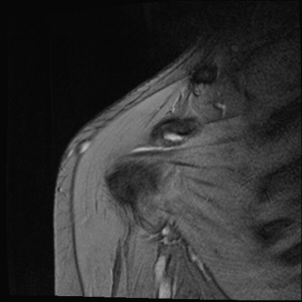 File:Avulsion fracture - greater tuberosity of humerus (Radiopaedia 71216-81515 Coronal T2 15).jpg