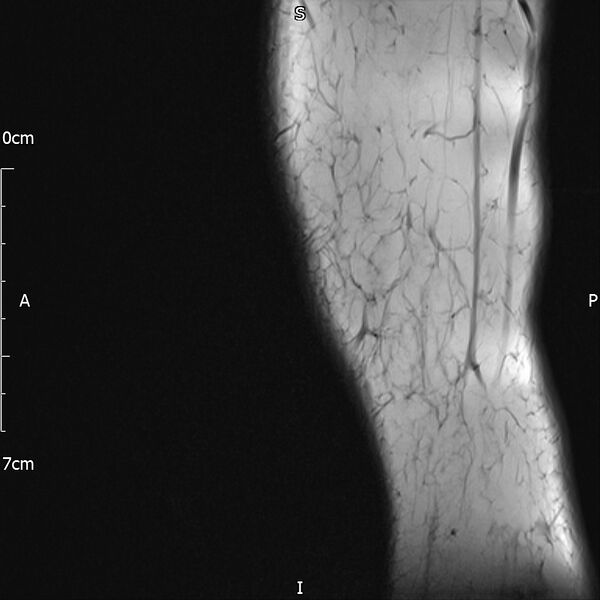 File:Avulsion fracture of the fibular head (Radiopaedia 74804-85808 D 2).jpg