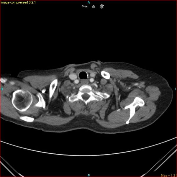 File:Azygos vein aneurysm (Radiopaedia 77824-90130 B 5).jpg