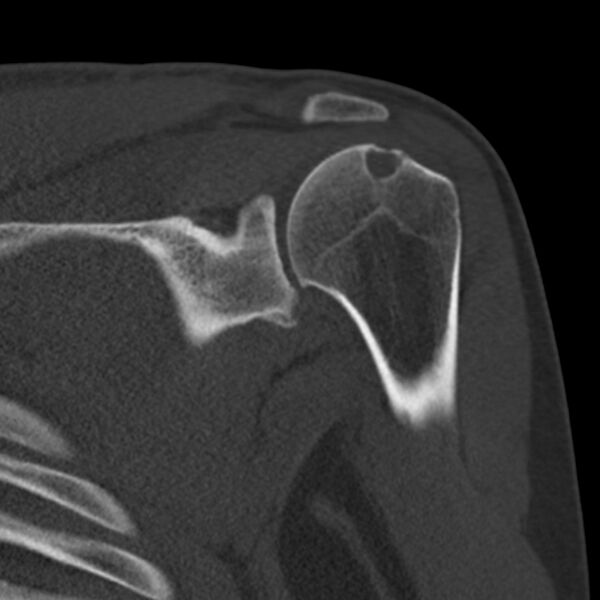 File:Bankart lesion (Radiopaedia 22771-22798 Coronal bone window 22).jpg