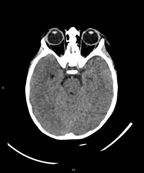 File:Basal ganglia and parenchymal ischemia (Radiopaedia 45818-50083 Axial non-contrast 30).jpg