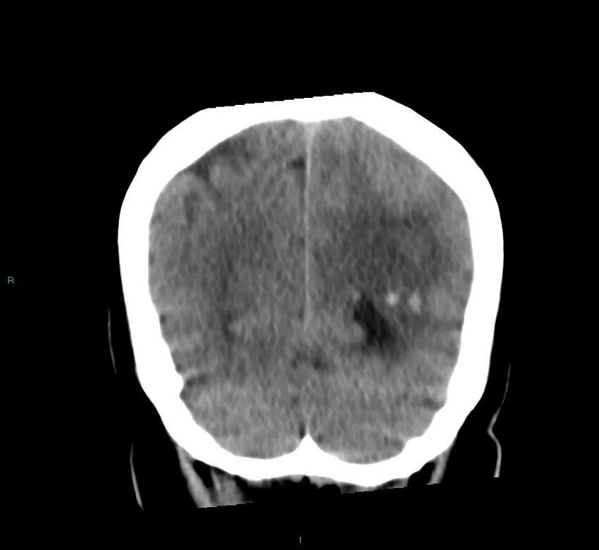 Basal ganglia hemorrhage (Radiopaedia 58759-65981 Coronal non-contrast 22).jpg
