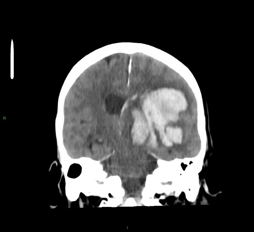 Basal ganglia hemorrhage (Radiopaedia 58767-65989 Coronal non-contrast 33).jpg