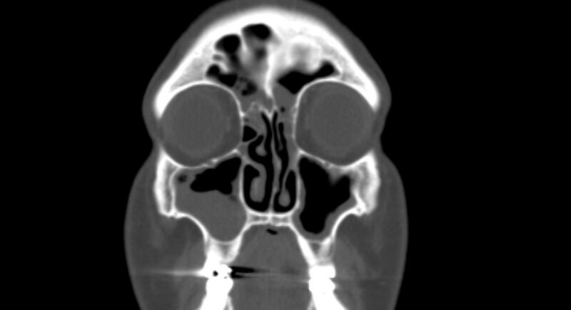 File:Benign mixed salivary tumor of the parotid gland (Radiopaedia 35261-36792 Coronal bone window 2).jpg