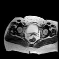 Benign seromucinous cystadenoma of the ovary (Radiopaedia 71065-81300 B 4).jpg