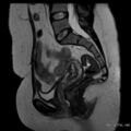 Bicornuate uterus- on MRI (Radiopaedia 49206-54297 Sagittal T2 13).jpg