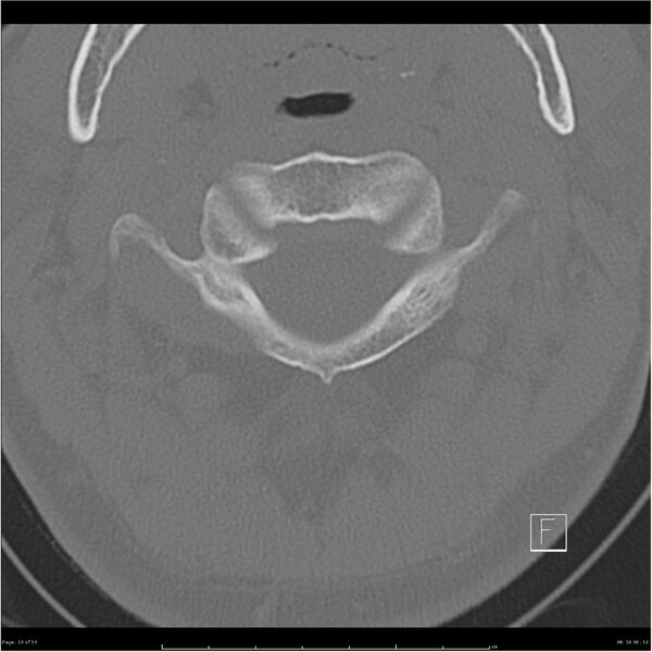 File:Bilateral cervical ribs (Radiopaedia 25868-26017 Axial bone window 10).jpg