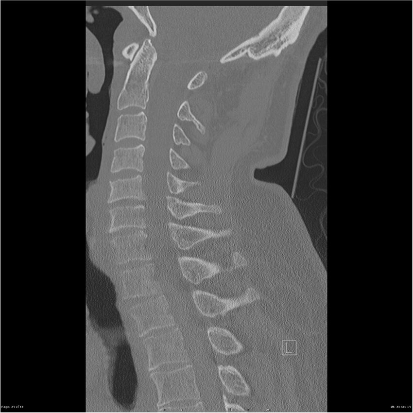 Bilateral cervical ribs (Radiopaedia 25868-26017 Sagittal bone window 34).jpg