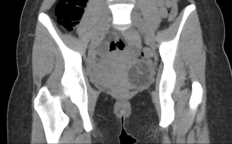 File:Bilateral mature cystic ovarian teratoma (Radiopaedia 88821-105592 Coronal non-contrast 15).jpg