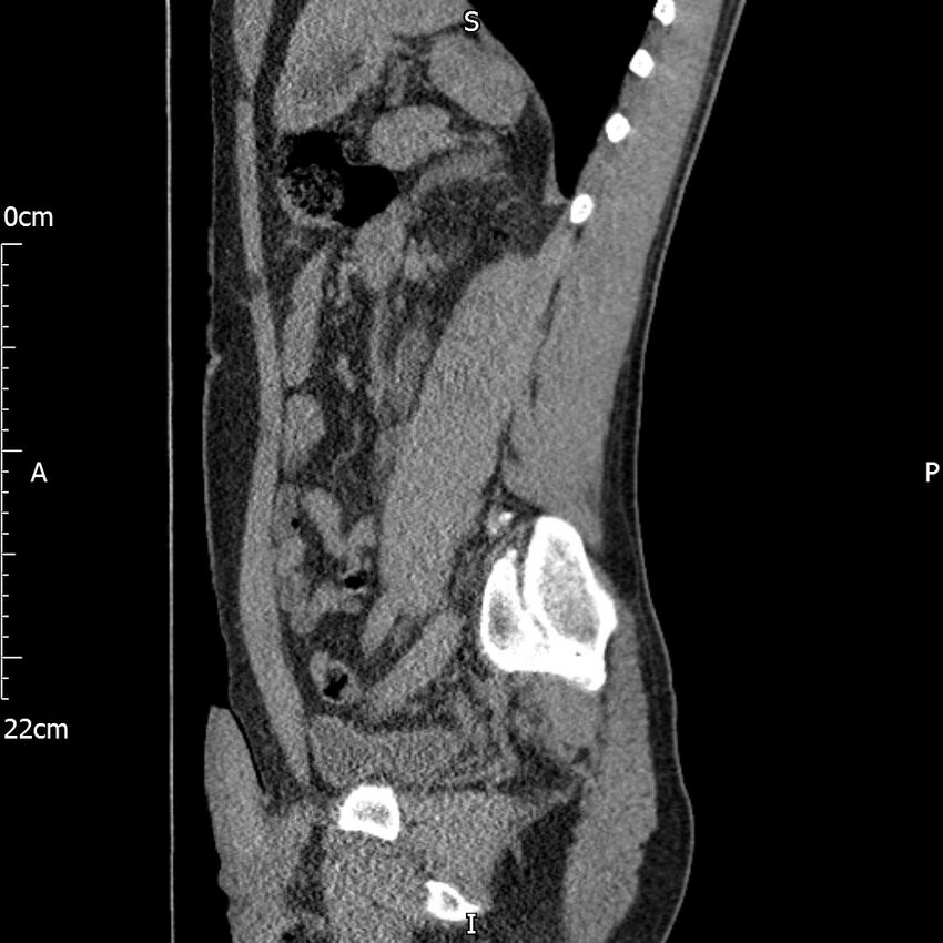 Bilateral medullary nephrocalcinosis with ureteric calculi (Radiopaedia 71269-81569 C 47).jpg