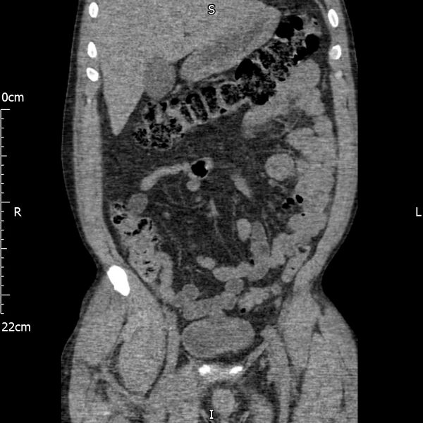 File:Bilateral medullary nephrocalcinosis with ureteric calculi (Radiopaedia 71269-81569 Coronal non-contrast 21).jpg