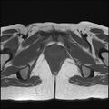 Bilateral ovarian endometriomas (Radiopaedia 87085-103347 Axial T1 21).jpg