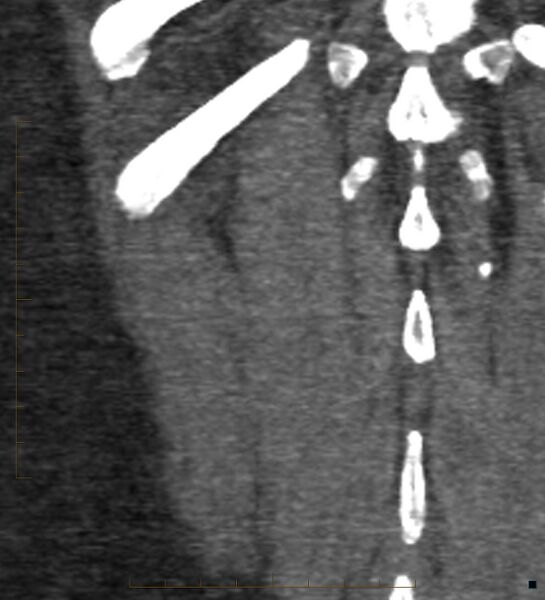 File:Bile leak from accessory duct(s) of Luschka post cholecystectomy (Radiopaedia 40736-43389 B 71).jpg