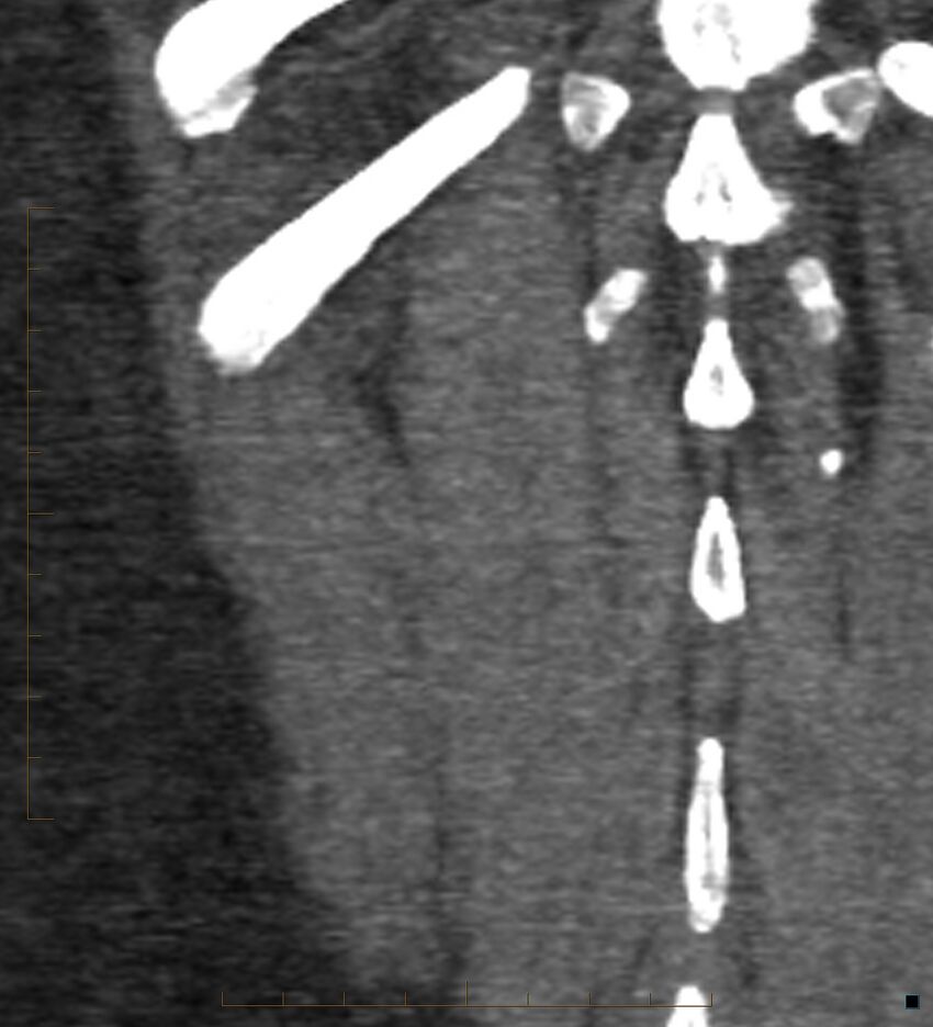 Bile leak from accessory duct(s) of Luschka post cholecystectomy (Radiopaedia 40736-43389 B 71).jpg