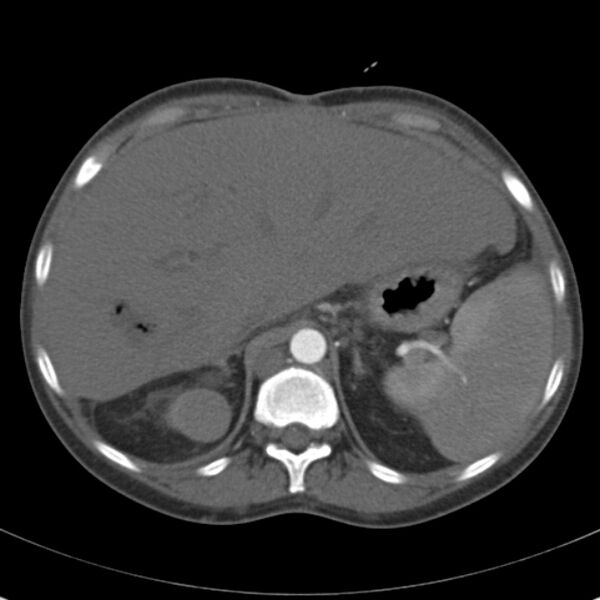 File:Biliary necrosis - liver transplant (Radiopaedia 21876-21846 A 17).jpg