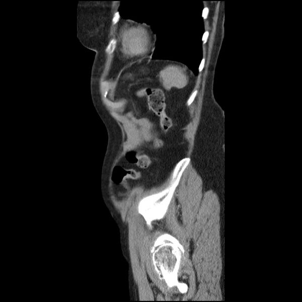 File:Bladder tumor detected on trauma CT (Radiopaedia 51809-57609 E 13).jpg
