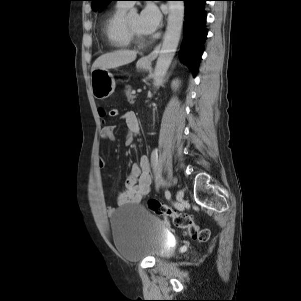 File:Bladder tumor detected on trauma CT (Radiopaedia 51809-57609 E 29).jpg