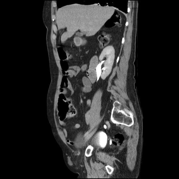 File:Bladder tumor detected on trauma CT (Radiopaedia 51809-57609 E 51).jpg
