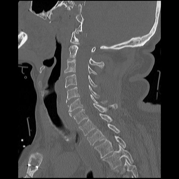 File:Blunt cerebrovascular injury (Radiopaedia 53682-59743 Sagittal bone window 11).png