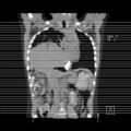 Bochdalek diaphragmatic hernia (Radiopaedia 38866-41059 A 39).jpg