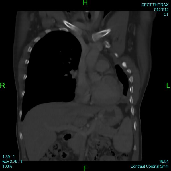 File:Bone metastases from lung carcinoma (Radiopaedia 54703-60937 Coronal bone window 19).jpg