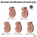 Bosniak classification of renal cysts (illustrations) (Radiopaedia 20989-20926 A 1).jpg