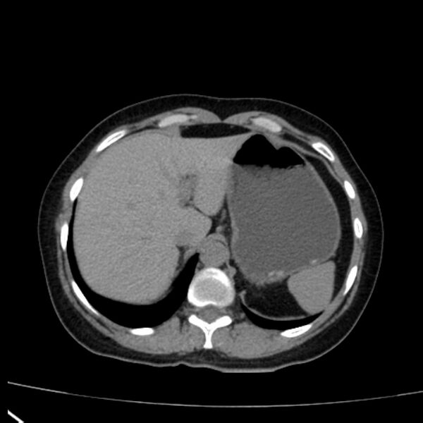 File:Bosniak renal cyst - type I (Radiopaedia 27479-27675 Axial non-contrast 16).jpg