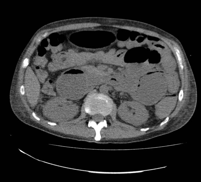 File:Bowel lymphoma complicated by bleeding after therapy (Radiopaedia 55601-62110 Axial non-contrast 33).jpg