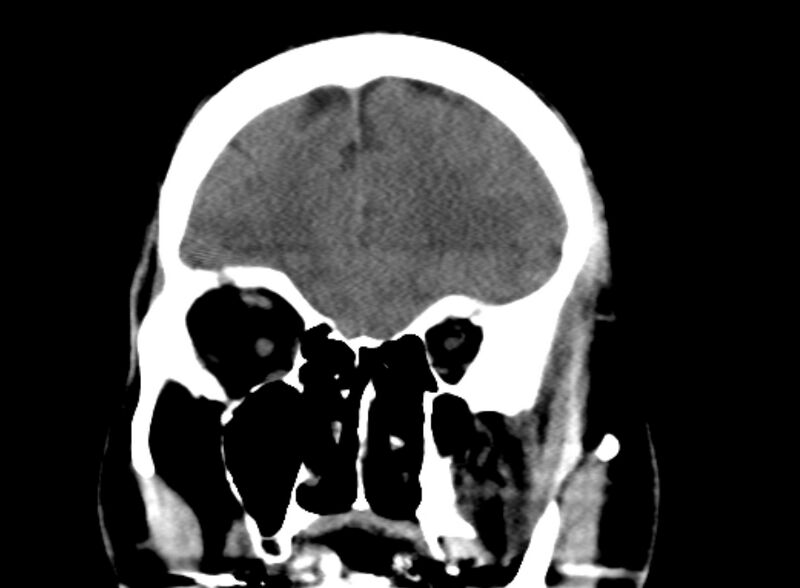 File:Brain abscess complicated by intraventricular rupture and ventriculitis (Radiopaedia 82434-96575 Coronal non-contrast 3).jpg