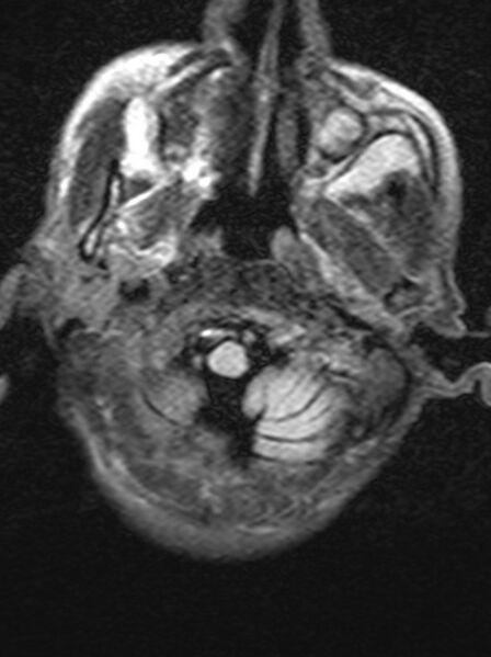 File:Brain abscess with dual rim sign (Radiopaedia 87566-103938 Axial FLAIR 1).jpg